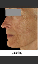  Physician - Prejuvenation before & after