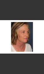 Chin Contouring & Sun Damage Treatment Physician- Prejuvenation Before & After