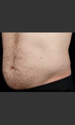 SculpSure Abdomen Physician- Prejuvenation before & after