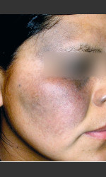 Quanta MDK Nevus of Ota Treatment #76 Physician- Prejuvenation before & after