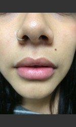 Juvederm Injection  Physician- Prejuvenation Before & After