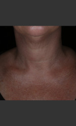 Alastin Skincare Restorative Neck Complex with TriHex Technology® Physician - Prejuvenation before & after