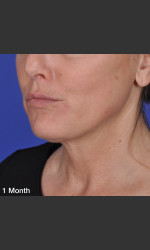 before_after/thermitight-treatment/17019 Physician- Prejuvenation Before & After