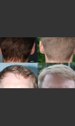 Neograft Hair Transplant Physician- Prejuvenation before & after