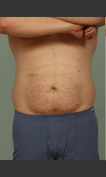 Liposuction Physician- Prejuvenation before & after
