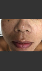 IPL Photofacial  Physician - Prejuvenation before & after