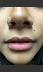  Physician - Prejuvenation before & after