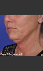 ThermiTight Treatment Physician - Prejuvenation before & after