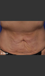 ThermiTight Treatment Physician- Prejuvenation Before & After