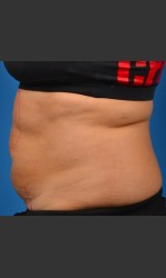 SculpSure Abdomen Physician - Prejuvenation before & after