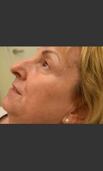 Fraxel Laser Treatment for Pigmentation Physician- Prejuvenation Before & After