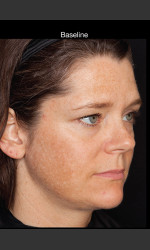 Hyperpigmentation - Professional Peel Physician- Prejuvenation before & after