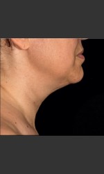 SculpSure Submental Physician - Prejuvenation Before & After