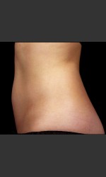 SculpSure Abdomen Physician- Prejuvenation Before & After