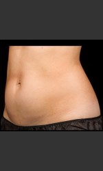 SculpSure Abdomen Physician - Prejuvenation before & after