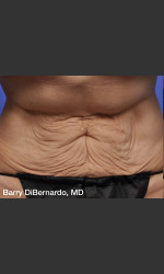 ThermiTight Treatment Physician - Prejuvenation before & after