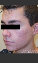 before_after/neoclear-by-aerolase-acne-treatment/16946 Physician- Prejuvenation Before & After