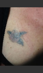 Laser Tattoo Removal  Physician- Prejuvenation before & after