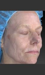Wrinkle and Brown Spot Reduction Physician- Prejuvenation before & after