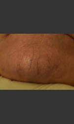 Cutera Laser Treatment Physician - Prejuvenation before & after