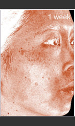 DefenAge Clinical Power Trio Physician - Prejuvenation Before & After