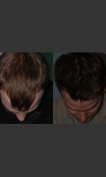 Neograft Hair Transplant Physician- Prejuvenation Before & After