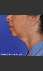 ThermiTight Treatment Physician - Prejuvenation before & after