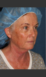 Chin Contouring & Sun Damage Treatment Physician- Prejuvenation before & after