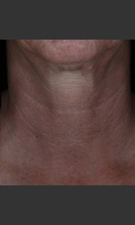 Alastin Skincare Restorative Neck Complex with TriHex Technology® Physician- Prejuvenation Before & After