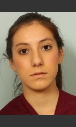 Rhinoplasty Surgery Physician- Prejuvenation before & after