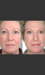 Two women with Laser Eyelid Blepharoplasty Physician - Prejuvenation before & after