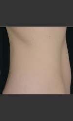 before_after/sculpsure-abdomen/18438 Physician- Prejuvenation Before & After