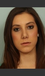 Rhinoplasty Surgery Physician- Prejuvenation Before & After