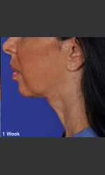 ThermiTight Treatment Physician - Prejuvenation Before & After