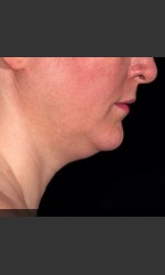 SculpSure Submental Physician- Prejuvenation Before & After