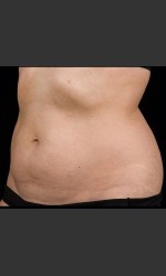 SculpSure Abdomen Physician- Prejuvenation Before & After