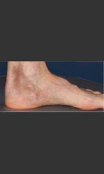 Treatment of Pigmented Lesion on Foot Physician - Prejuvenation Before & After