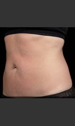 SculpSure Abdomen Physician - Prejuvenation Before & After