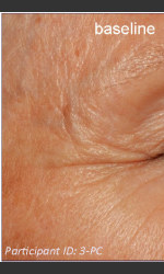 DefenAge Clinical Power Trio Physician - Prejuvenation before & after