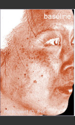 DefenAge Clinical Power Trio Physician - Prejuvenation before & after