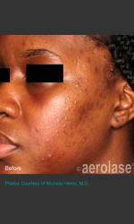 NeoClear by Aerolase Acne Treatment Physician - Prejuvenation before & after