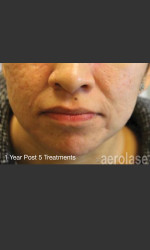 NeoClear by Aerolase Acne Treatment Physician- Prejuvenation Before & After