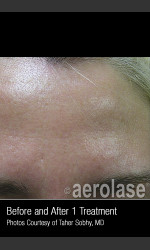 Treatment of Pores and Skin Texture #338 Physician - Prejuvenation Before & After