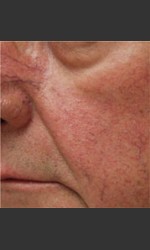 Dr. Langdon IPL Treatment  Physician- Prejuvenation before & after