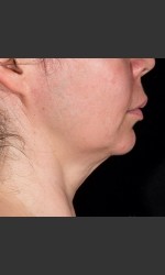 SculpSure Submental Physician - Prejuvenation Before & After
