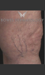Spider Vein Treatment Physician - Prejuvenation before & after