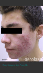 NeoClear by Aerolase Acne Treatment Physician - Prejuvenation before & after