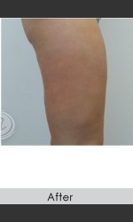 VanquishME with Cellutone Treatment Physician - Prejuvenation Before & After