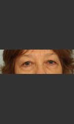 Eyelid Surgery Physician - Prejuvenation before & after