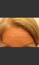 Before & After Botox Physician - Prejuvenation before & after